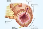 The diverticulosis