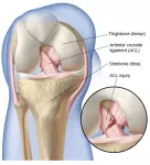 ACL injury | Tearing of the anterior cruciate ligament