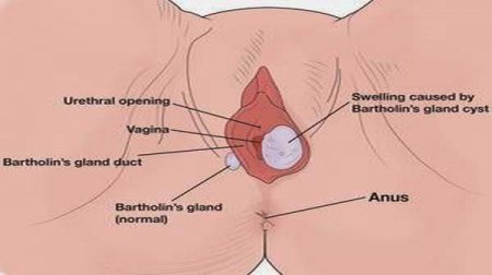 Bartholin's cyst