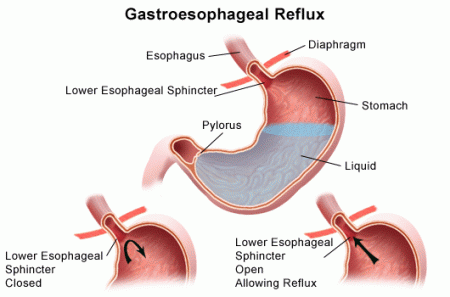 GERD - Gastroesophageal reflux disease (Acid reflux)