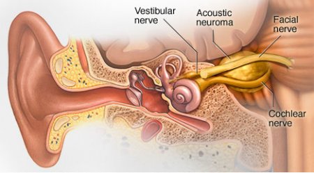 Acoustic neuroma