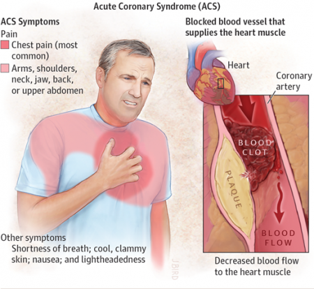 Acute coronary syndrome