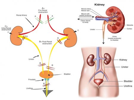 Acute kidney failure