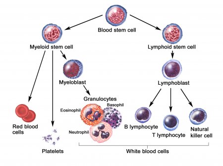 Acute lymphocytic leukemia (ALL)