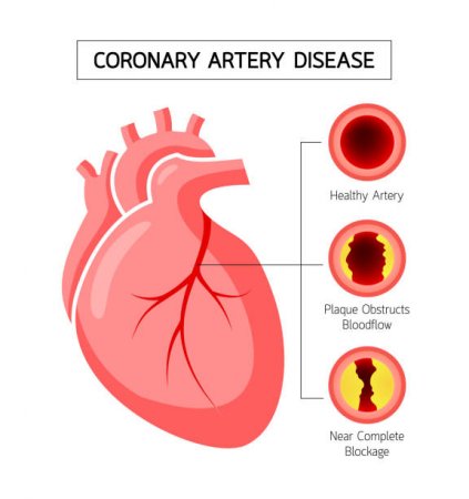 Coronary artery disease (CAD)