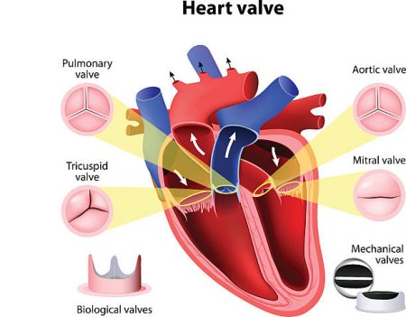 Heart valve disease