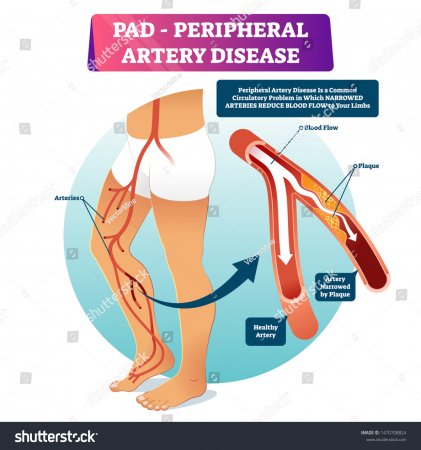 Peripheral artery disease (PAD)
